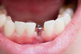 Close-up of an unrestored dental implant in Painesville, OH