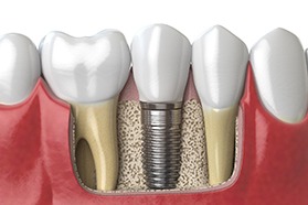 Illustration of a dental implant in Painesville, OH in lower arch