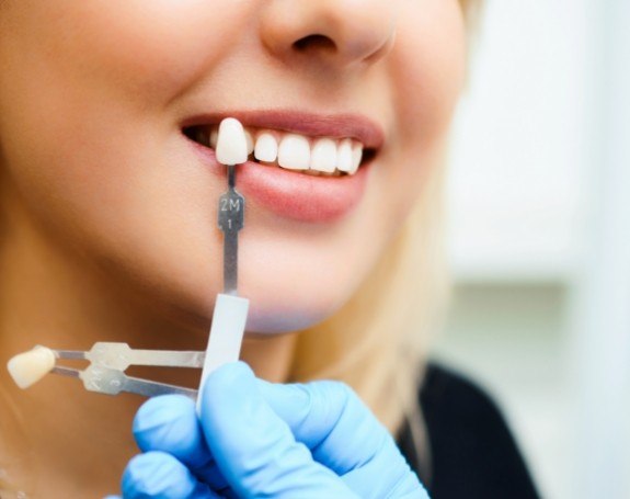 Woman's smile compared with porcelain veneers