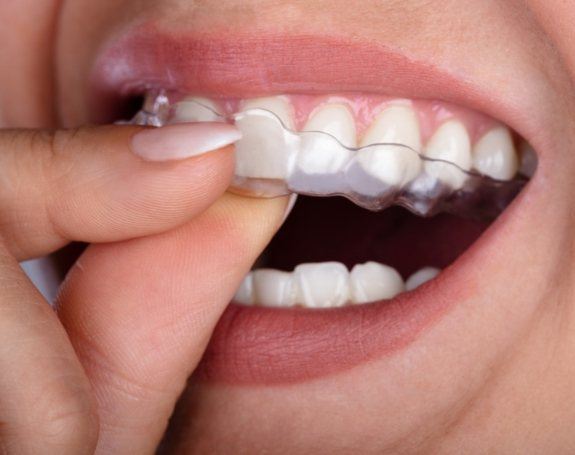 Closeup of patient placing an Invisalign clear aligner