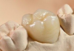 Model smile with dental crown restoration