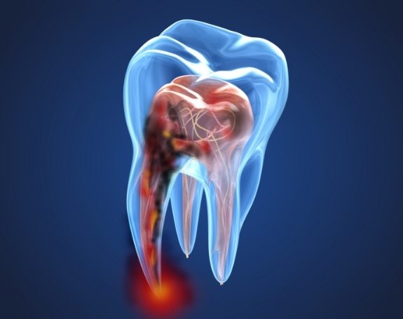 Animated tooth in need of root canal therapy