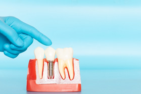 a model of dental implants