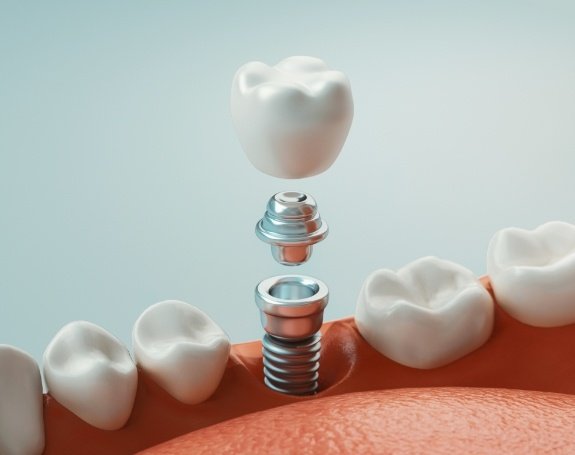 Animated dental implant supported dental crown placement