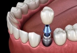 Animated dental implant supported dental crown placement