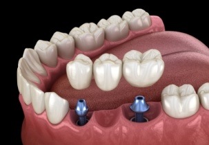 Animated dental implant supported fixed bridge placement