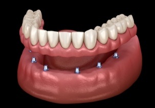 Animated dental implant supported denture placement