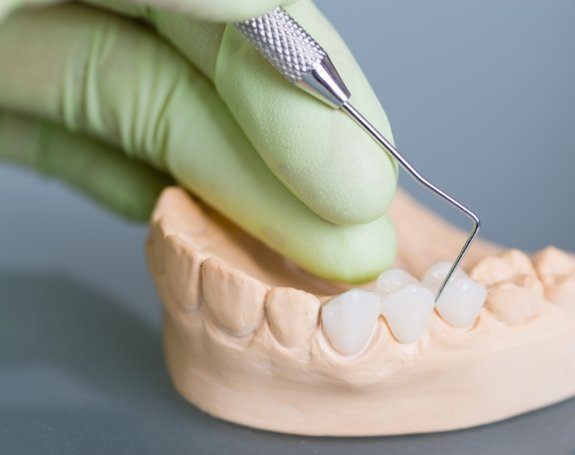 Model smile with dental crown supported fixed bridge