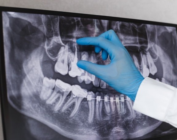 X-ray of damaged tooth in need of root canal therapy