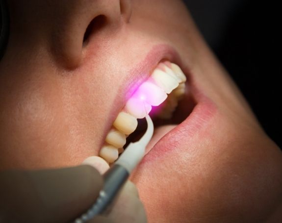 Patient receiving soft tissue laser dentistry