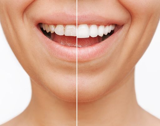 Patient's smile before and after veneers