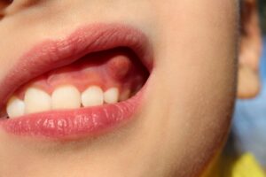 Bump on gums. 
