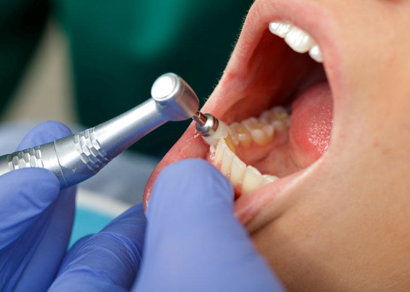 dentist doing teeth cleaning