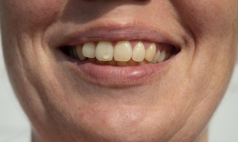 Man with white spots on teeth