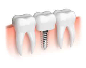 dental implants in Jefferson